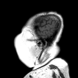 File:Neurofibromatosis type 2 (Radiopaedia 8713-9518 Sagittal T1 19).jpg