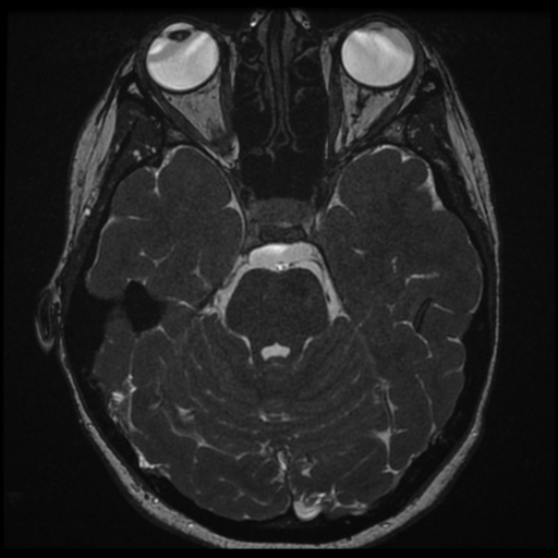 Neurofibromatosis type 2 - bilateral acoustic neuromata (Radiopaedia 40060-42566 Axial FIESTA 63).png