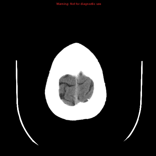 File:Neuroglial cyst (Radiopaedia 10713-11185 Axial non-contrast 4).jpg