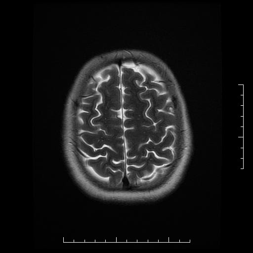 File:Neuroglial cyst of brainstem (Radiopaedia 29134-29526 Axial T2 18).jpg