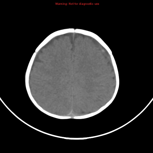 File:Non-accidental injury - bilateral subdural with acute blood (Radiopaedia 10236-10765 Axial non-contrast 16).jpg