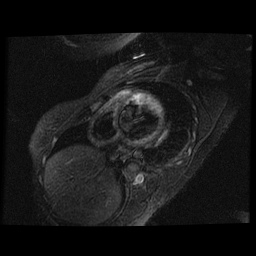 File:Non-compaction of the left ventricle (Radiopaedia 38868-41062 D 13).jpg