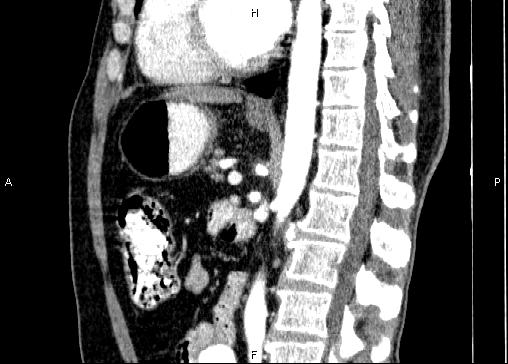 Non-syndromic pancreatic endocrine tumor (Radiopaedia 86958-103178 E 57).jpg