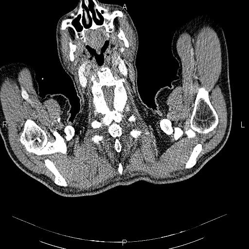 File:Non Hodgkin lymphoma in a patient with ankylosing spondylitis (Radiopaedia 84323-99621 B 1).jpg