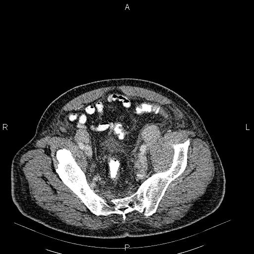 File:Non Hodgkin lymphoma in a patient with ankylosing spondylitis (Radiopaedia 84323-99621 B 56).jpg