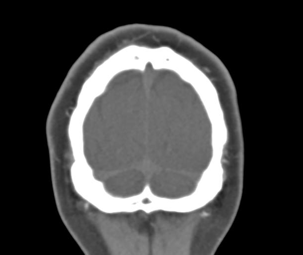 File:Normal CTA head (Radiopaedia 40801-43464 B 88).png