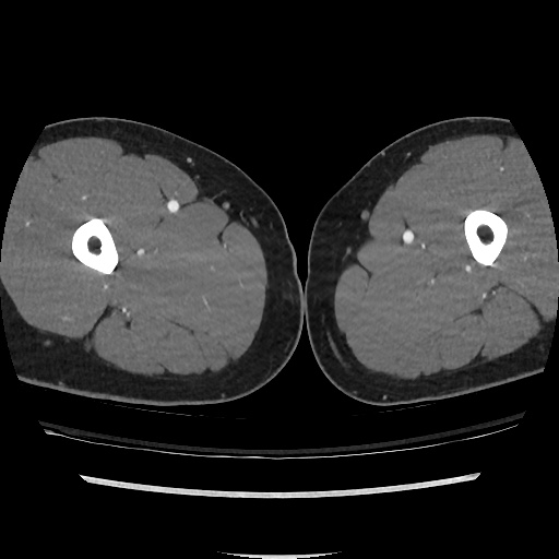 File:Normal CT angiogram of pelvis (Radiopaedia 45390-49430 A 86).jpg