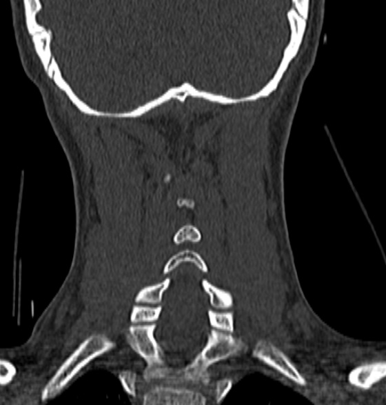 File:Normal CT cervical spine - 12-year-old (Radiopaedia 55352-61775 Coronal bone window 168).jpg