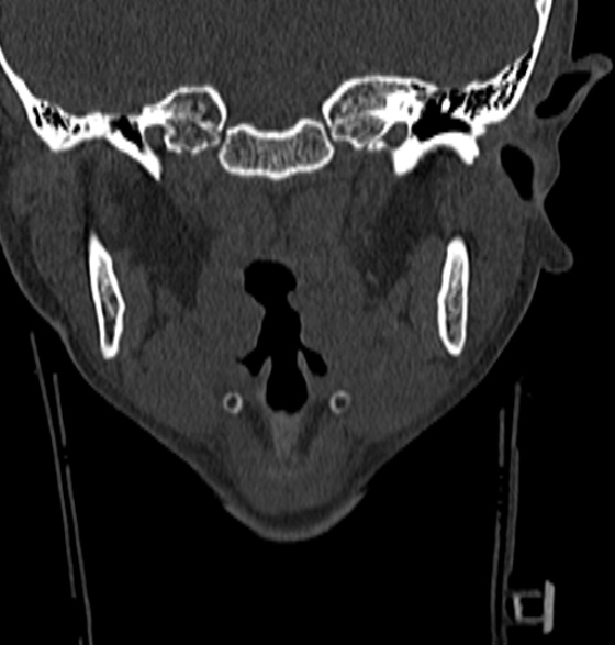 File:Normal CT cervical spine - 12-year-old (Radiopaedia 55352-61775 Coronal bone window 7).jpg