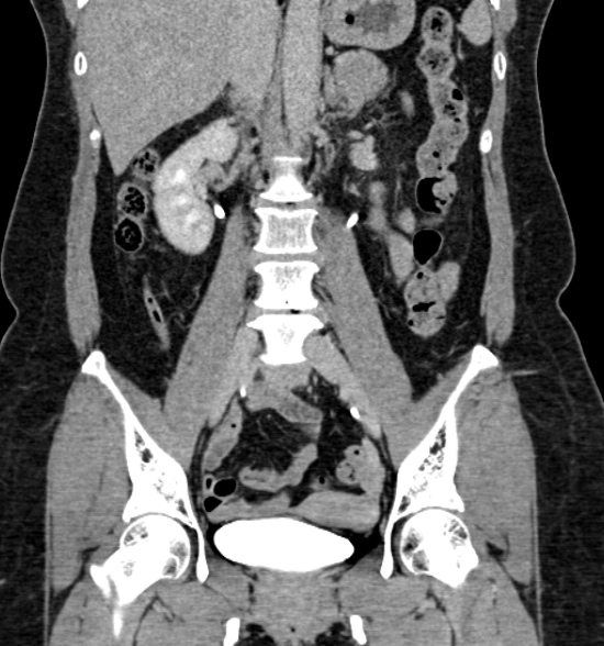 Normal CT intravenous urogram (Radiopaedia 39444-41759 A 277).jpg