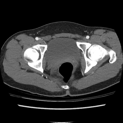 Normal CT intravenous urogram (Radiopaedia 39444-41759 A 318).jpg
