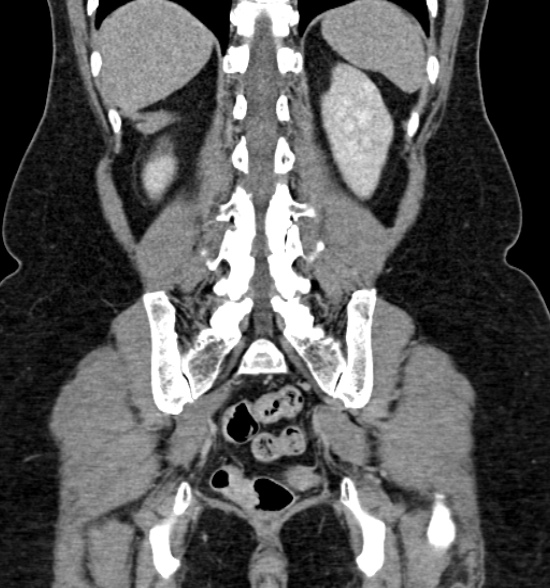 Normal CT intravenous urogram (Radiopaedia 39444-41759 A 336).jpg