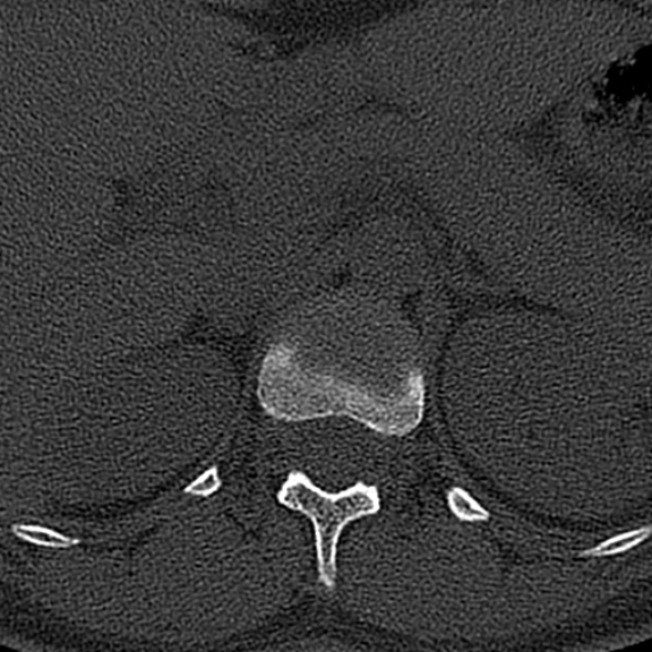File:Normal CT lumbar spine (Radiopaedia 53981-60118 Axial bone window 5).jpg