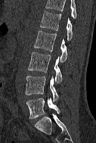 File:Normal CT lumbar spine (Radiopaedia 53981-60118 Sagittal bone window 58).jpg