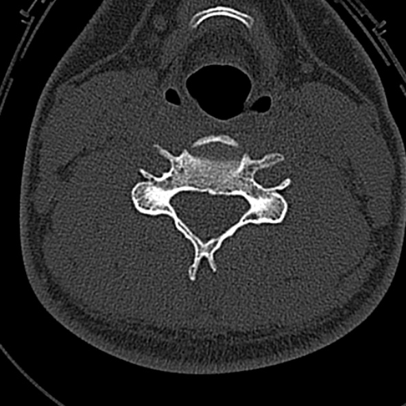 Normal CT of the cervical spine (Radiopaedia 53322-59305 Axial bone window 154).jpg