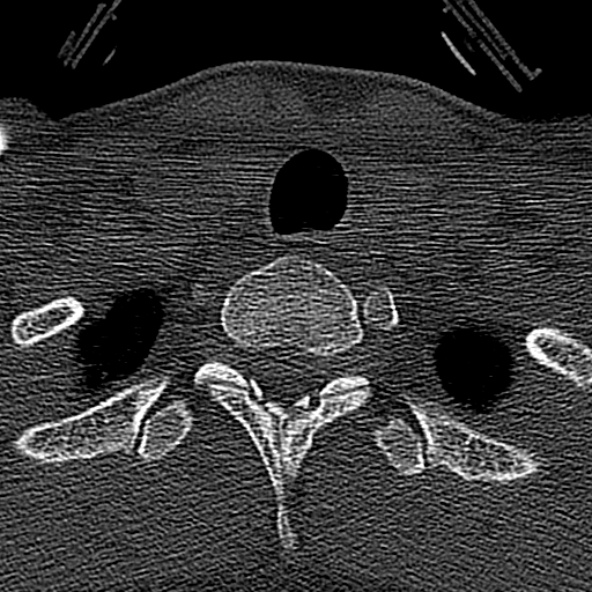 Normal CT of the cervical spine (Radiopaedia 53322-59305 Axial bone window 243).jpg