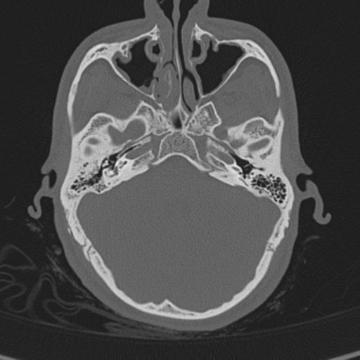 Normal CT skull (Radiopaedia 40798-43459 A 39).png