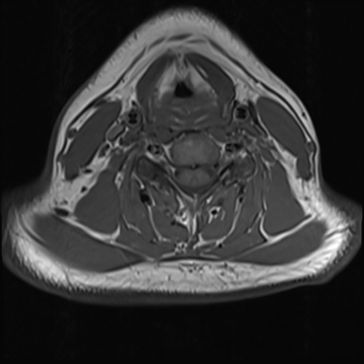File:Normal MRI cervical spine (infection protocol) (Radiopaedia 53916-60039 Axial 30).png