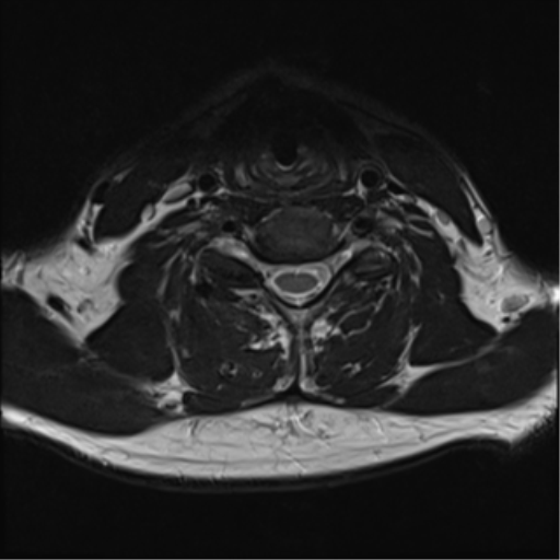 File:Normal MRI cervical spine (infection protocol) (Radiopaedia 53916-60039 Axial T2 34).png