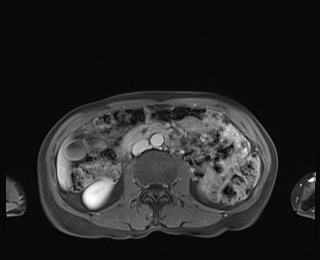 Normal adrenal glands MRI (Radiopaedia 82017-96004 M 50).jpg