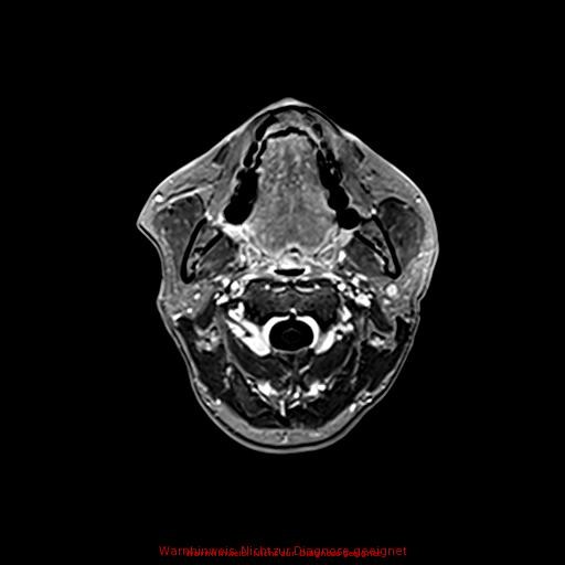 Normal adult brain MRI (non-enhanced and contrast-enhanced) (Radiopaedia 75262-86379 Axial T1 C+ 18).jpg