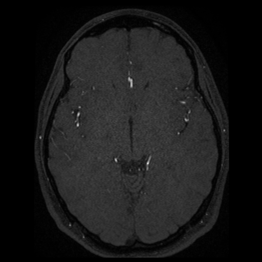 Normal brain MRA (Radiopaedia 41046-43793 Axial MRA 33).png