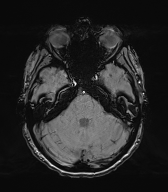 Normal brain MRI (TLE protocol) (Radiopaedia 40748-43405 Axial SWI 25).png