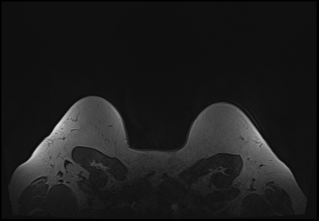 File:Normal breast MRI - dense breasts (Radiopaedia 80454-93850 Axial T1 208).jpg