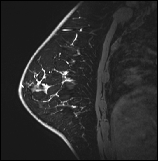 Normal breast MRI - dense breasts (Radiopaedia 80454-93850 I 134).jpg