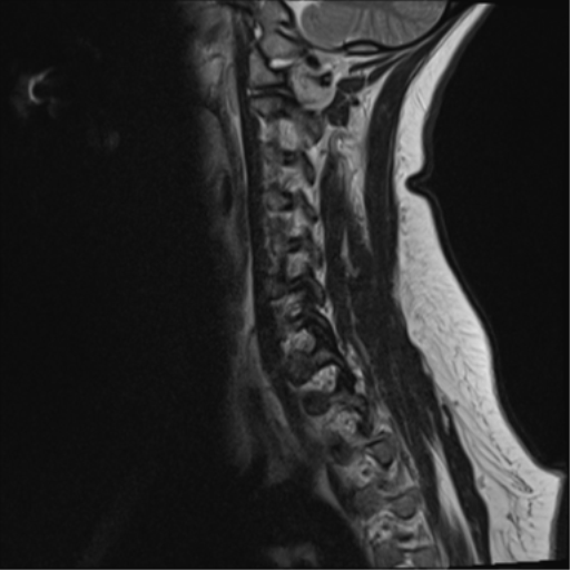 File:Normal cervical spine MRI (including Dixon) (Radiopaedia 42762-45925 Dixon- in-phase 4).png