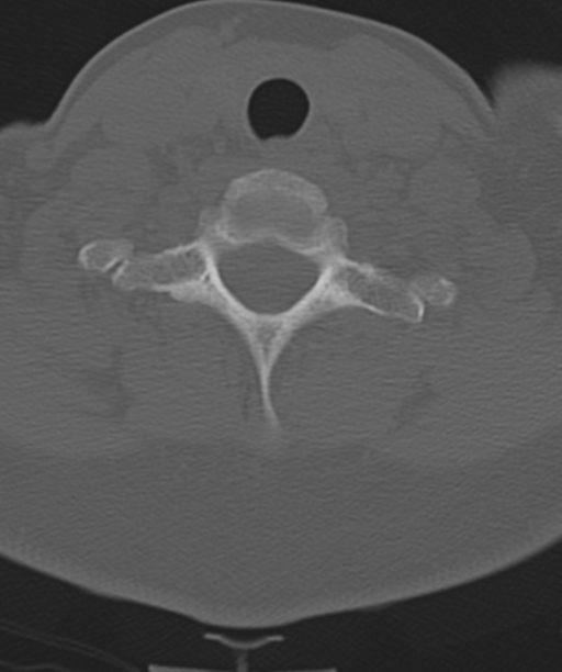 Normal cervical spine MRI (including Dixon) (Radiopaedia 42762-45926 Axial bone window 47).png