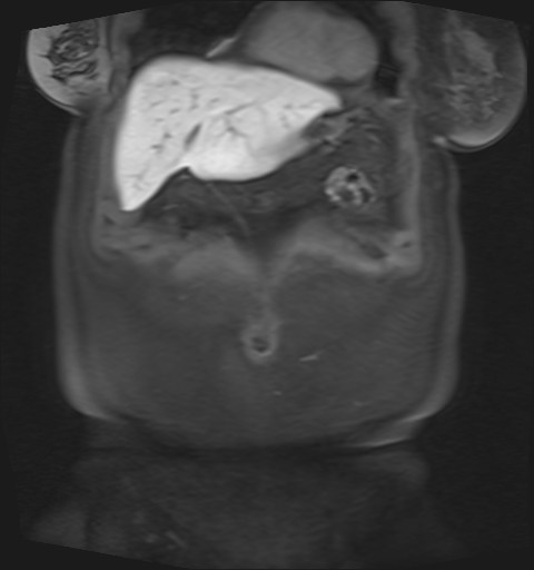 File:Normal hepatobiliary phase liver MRI (Radiopaedia 58968-66230 B 44).jpg