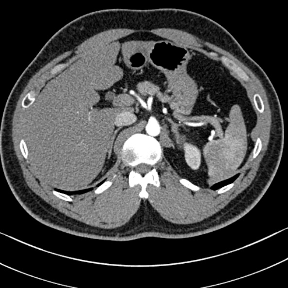 Normal kidneys on 4-phase CT study (Radiopaedia 25889-26038 B 5).jpg