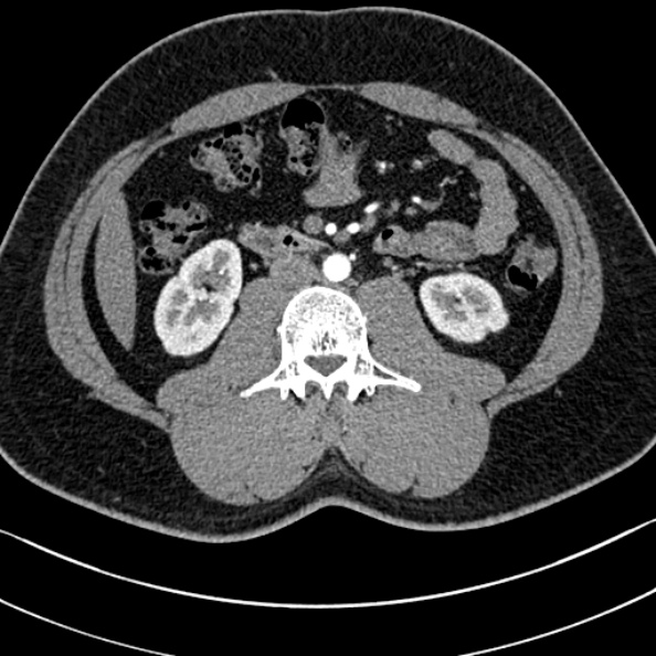 Normal kidneys on 4-phase CT study (Radiopaedia 25889-26038 B 61).jpg