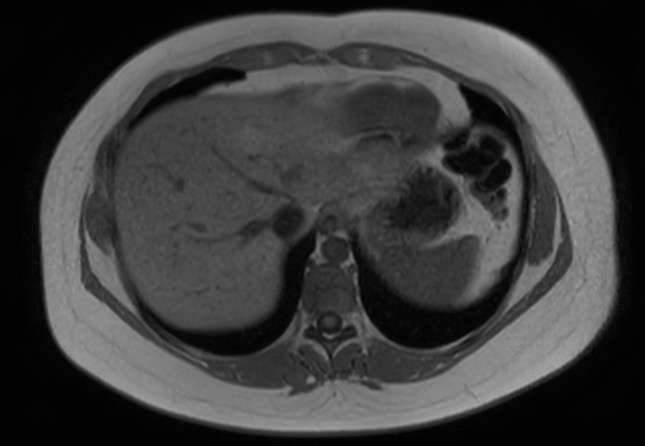 File:Normal liver MRI with Gadolinium (Radiopaedia 58913-66163 Axial T1 in-phase 27).jpg