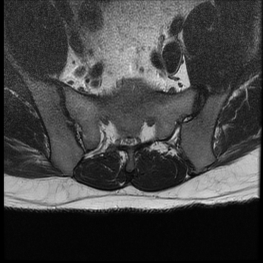 File:Normal lumbar spine MRI (Radiopaedia 35543-37039 Axial T2 2).png