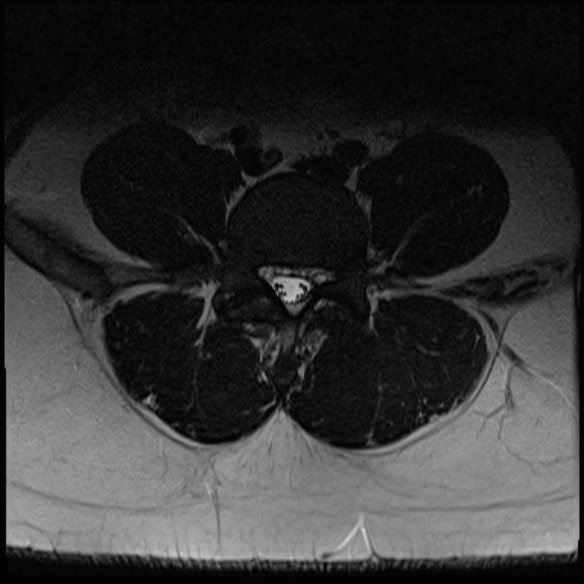 File:Normal lumbar spine MRI (Radiopaedia 47857-52609 Axial T2 20).jpg