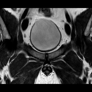 File:Normal prostate (MRI) (Radiopaedia 29986-30535 Coronal T2 1).jpg