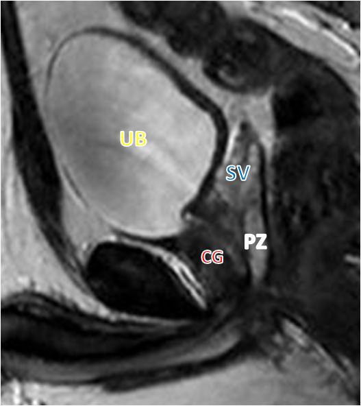 File:Normal prostate (MRI) (Radiopaedia 29986-30536 F 1).png