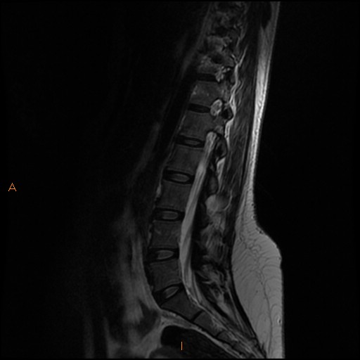 File:Normal spine MRI (Radiopaedia 77323-89408 Sagittal T2 9).jpg