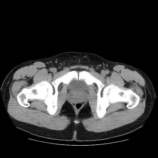 File:Obstructing ureteric calculus (Radiopaedia 18615-18514 Axial non-contrast 56).jpg