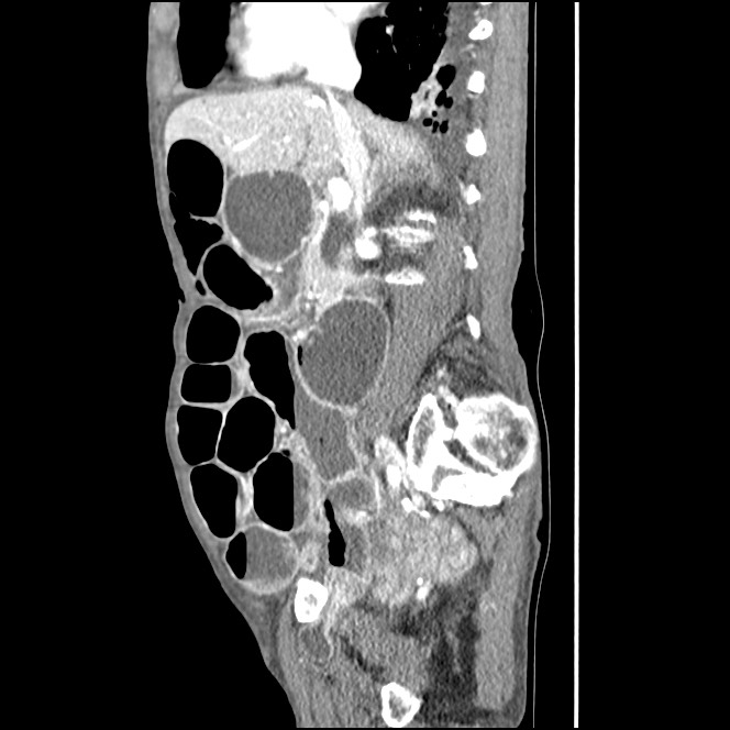 Obturator hernia causing small bowel obstruction (Radiopaedia 65522-74612 C 62).jpg