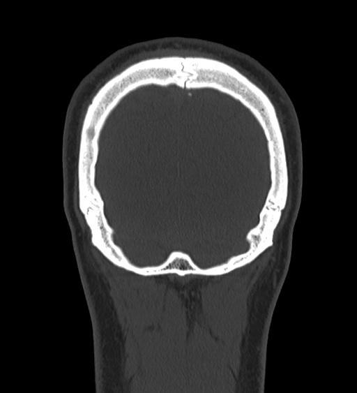 Occipital spur and Currarino type A atlas anomaly (Radiopaedia 87027-103285 Coronal bone window 127).jpg