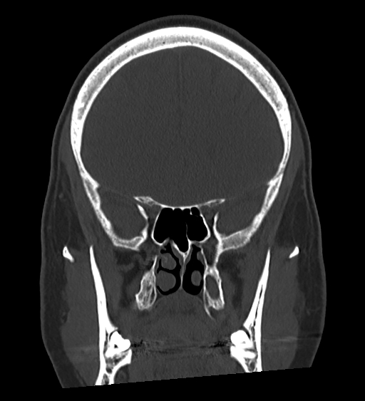 Occipital spur and Currarino type A atlas anomaly (Radiopaedia 87027-103285 Coronal bone window 61).jpg