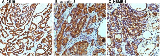 a-c)Immunohistochemical (CK19, galetin-3, HBME-1) staining of malignant struma ovarii tissues