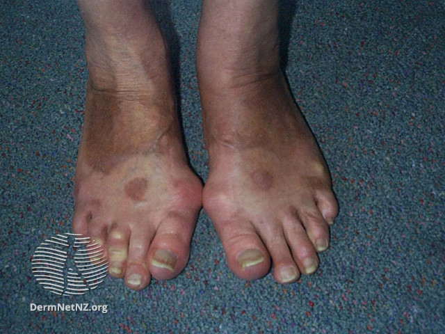 File:Topical PUVA followed by sun exposure has caused phototoxic pigmentation on uncovered skin (DermNet NZ colour-photo-tan).jpg