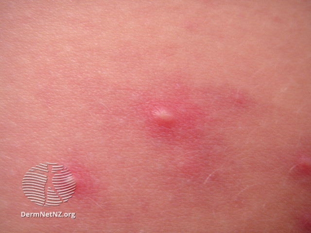 File:(DermNet NZ acne-folliculitis-2657).jpg