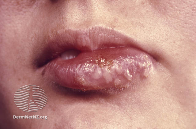 File:(DermNet NZ herpes-simplex-labialis-09).jpg