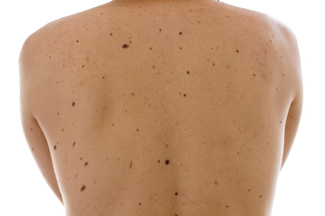 File:A back with many moles (DermNet NZ iStock-696719154).jpg