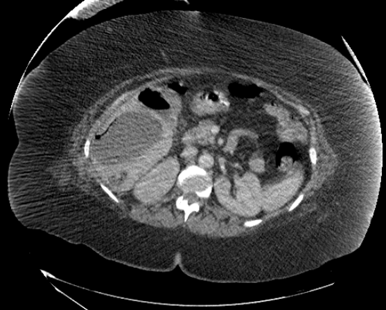 File:Abdominal abscess - pre and post percutaneous drainage (Radiopaedia 60209-67816 Axial 39).png